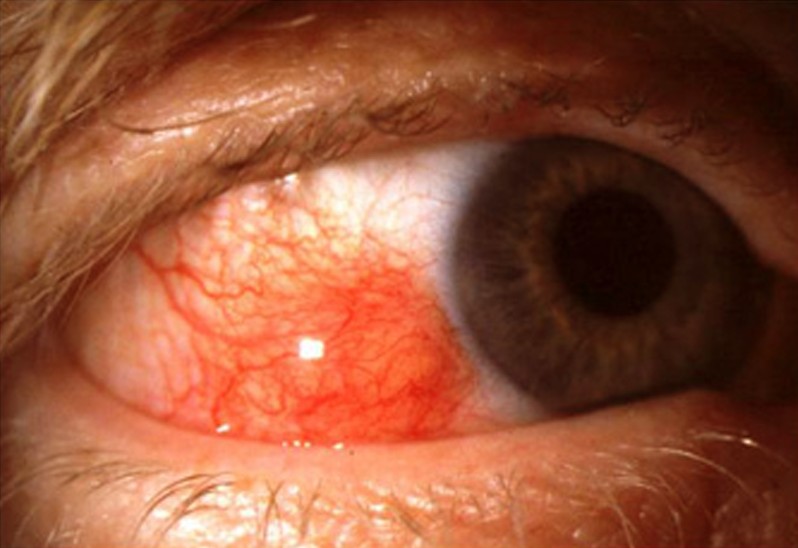 Episcleritis Pictures