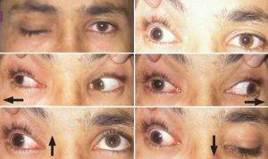 Cranial Nerve 4 Palsy » Eye Care Specialists, Optometrists at Noel ...